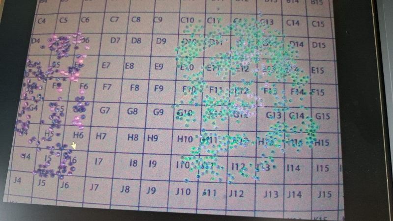 DiaTrue CXL3 AI automatic stone recognition and analysis result screen